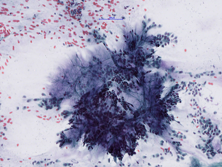 Zytologische Untersuchung, Bild von Parotis, pleomorphes Adenom